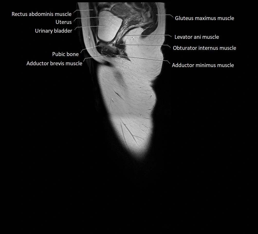 Thigh sagittal cross sectional anatomy MRI 3T image 22.webp